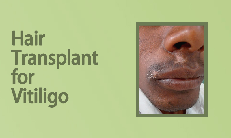 Hair Transplant for Vitiligo