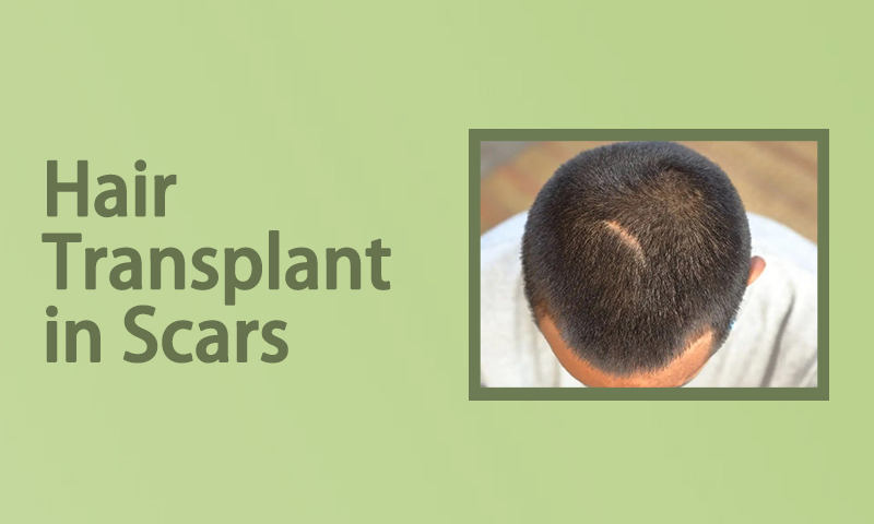 Hair Transplant in Scars