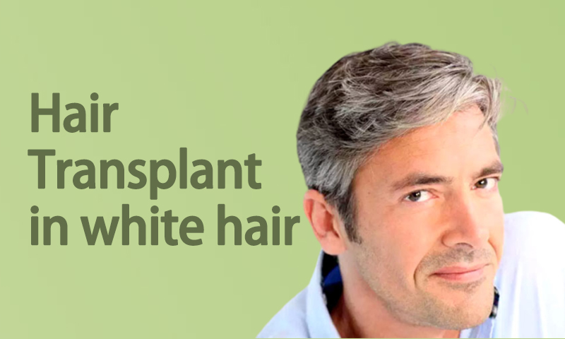 Hair Transplant In White Hair