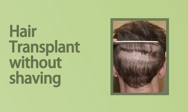 Hair Transplant without shaving
