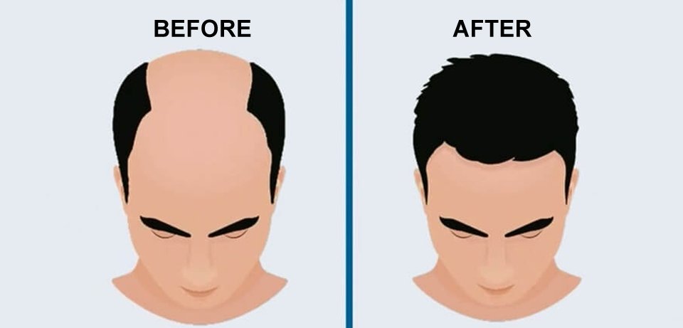 Unit by Unit Technique Hair Transplant in Surat, Gujarat (India)