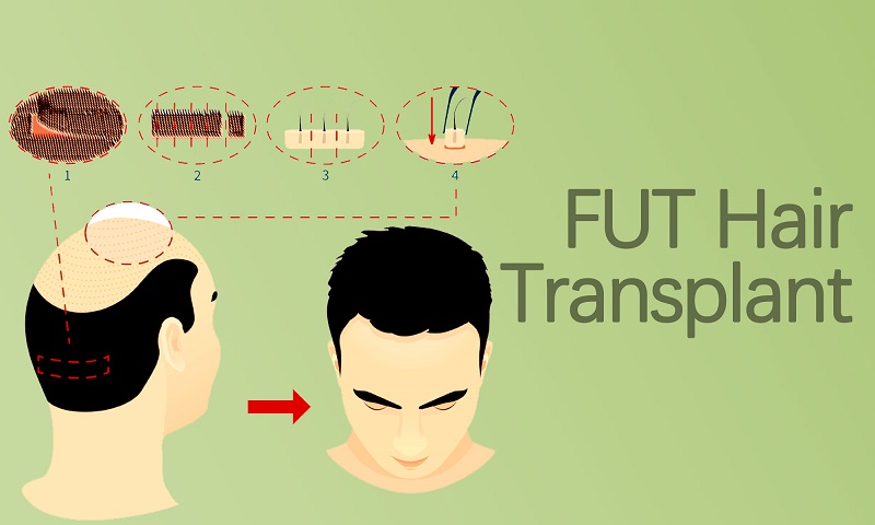 Follicular Unit Transplantation