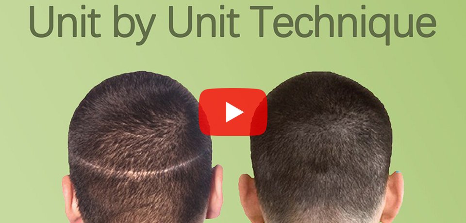 Unit by Unit Technique Hair Transplant in Surat, Gujarat (India)