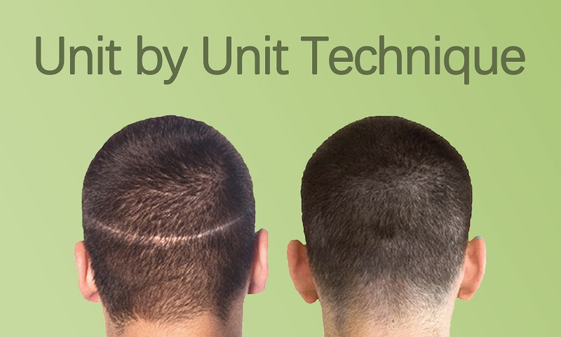 Unit by Unit Technique Hair Transplant in Surat, Gujarat (India)