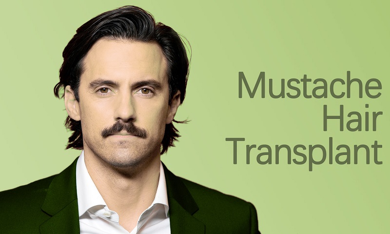 Mustache Hair Transplant in Surat, Gujarat (India)