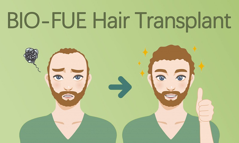 BIO-FUE Hair Transplantation