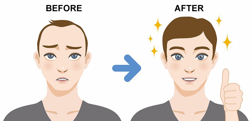 Body Hair Transplantation in Surat, Gujarat (India)