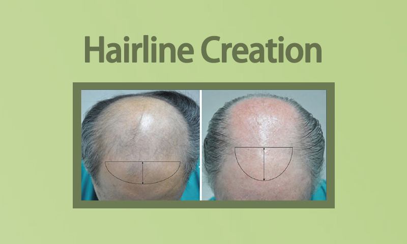 Hairline Creation