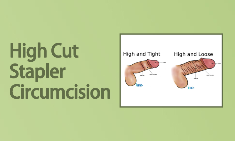 High Cut Stapler Circumcision