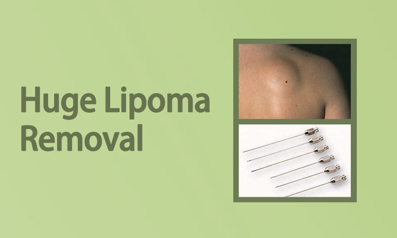 Huge Lipoma Removal