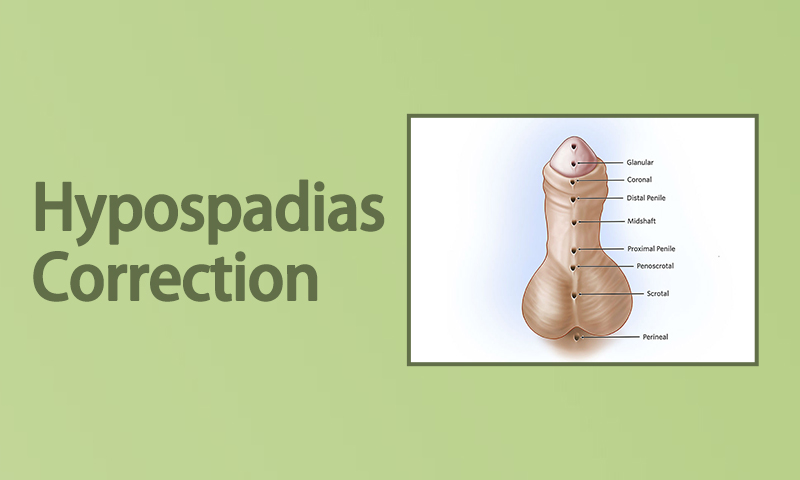 Hypospadias Correction