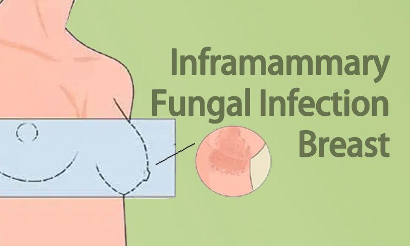 Inframammary Fungal Infection Breast in Surat, Gujarat (India)