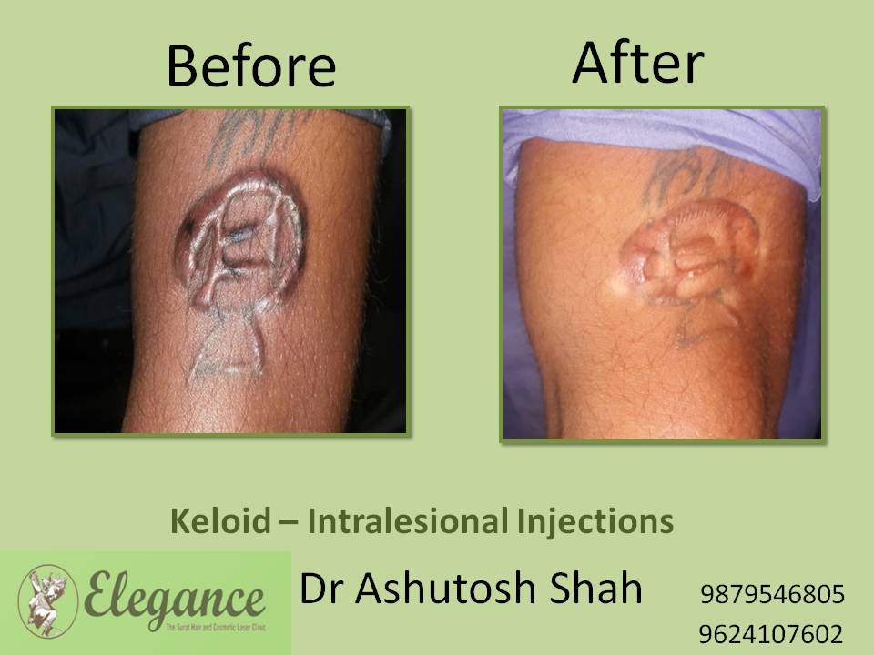 Intralesional Injections