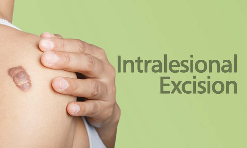 Intralesional Excision