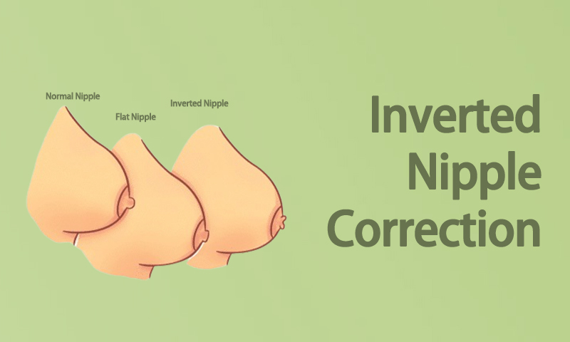 Breast Inverted Nipple Correction Surgery in Surat, Gujarat (India)