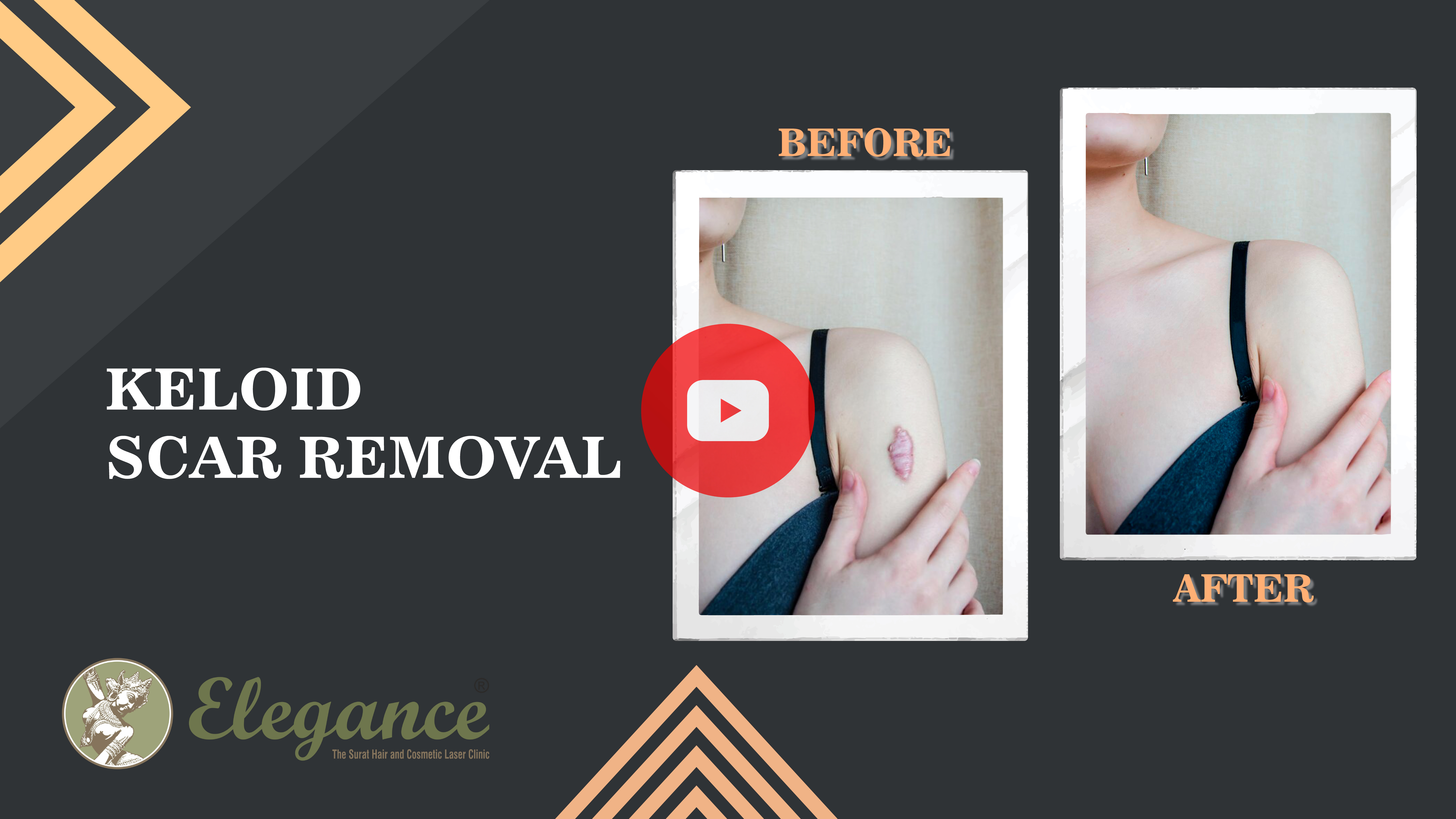 Keloid Revision Surgery