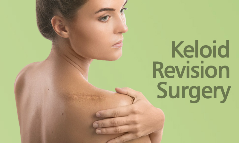 Keloid Revision Surgery