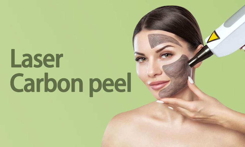 Laser Carbon Peel