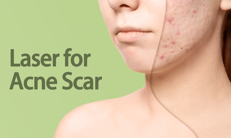 Laser for Acne Scar