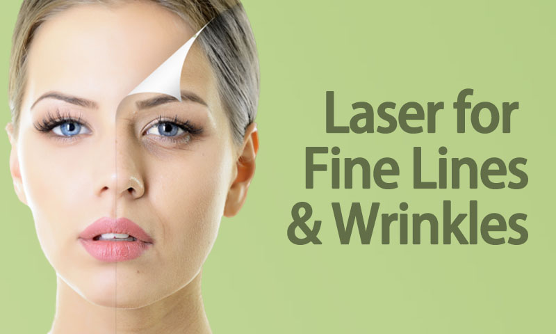 Laser for Fine Lines and Wrinkles