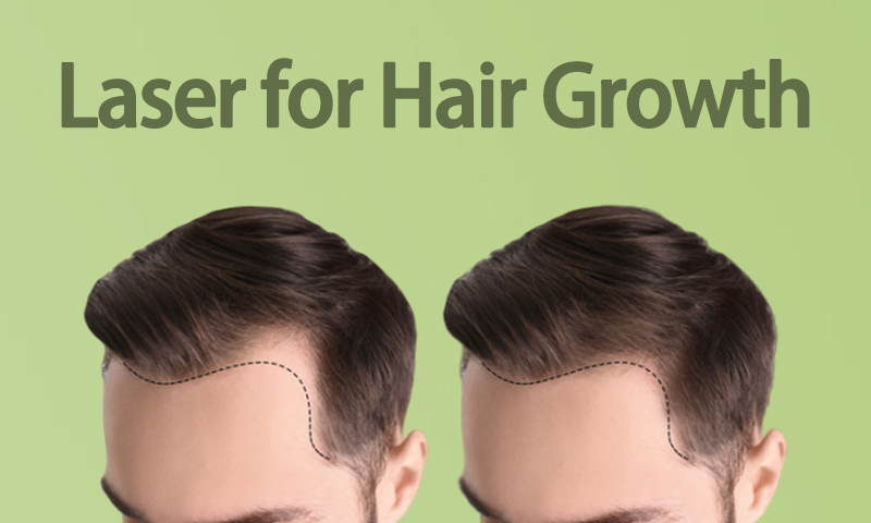 Laser for Hair Growth