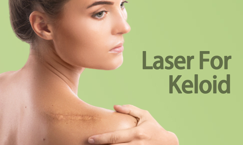 Laser For Keloid