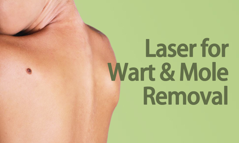 Laser for Wart & Mole Removal