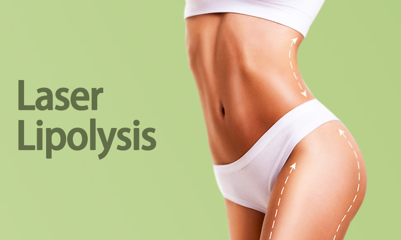 Laser Lipolysis