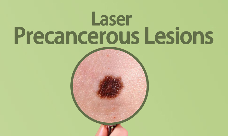 Laser Precancerous Lesions
