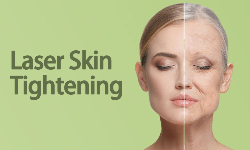 Laser Skin Tightening