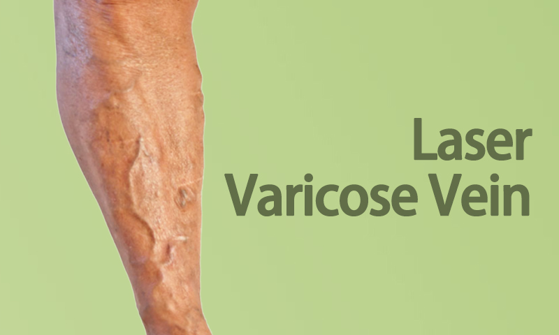 Laser Varicose Vein