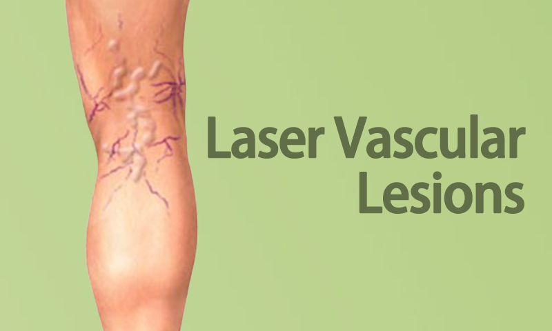 Laser Vascular Lesions