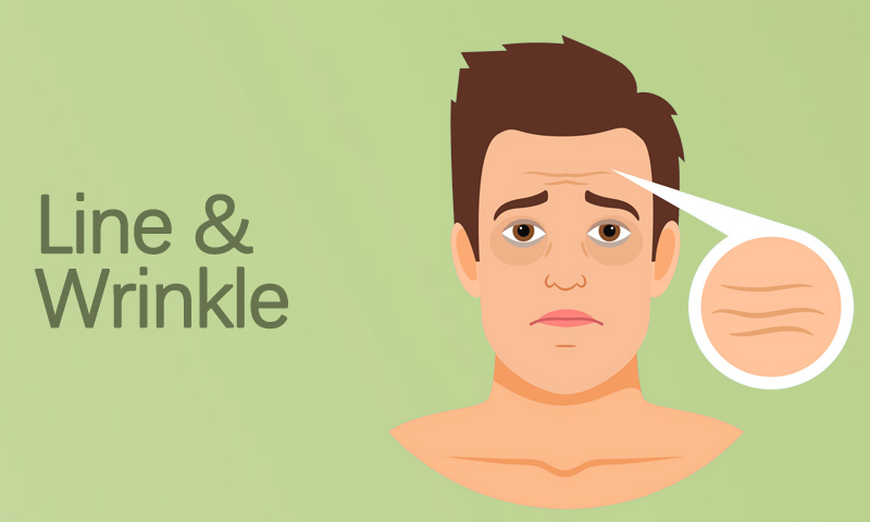 Line & Wrinkle Treatment in Surat, Gujarat (India)