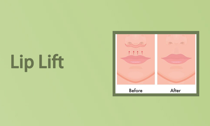 Lip Lift