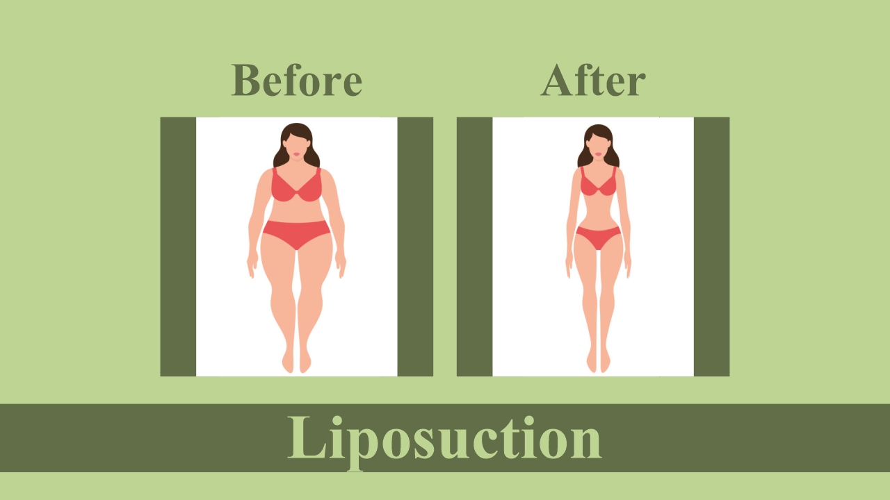Flanks Male Liposuction