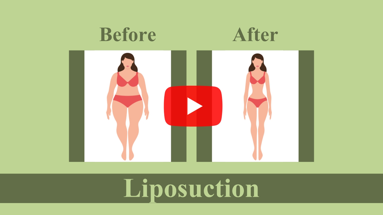Legs and Ankles Liposuction