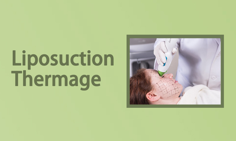 Liposuction Thermage