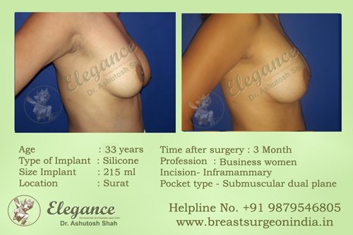 Fat Transfer For Breast Augmentation