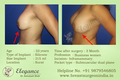 Fat Transfer For Breast Augmentation