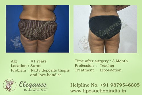 Fat Transfer For Buttocks