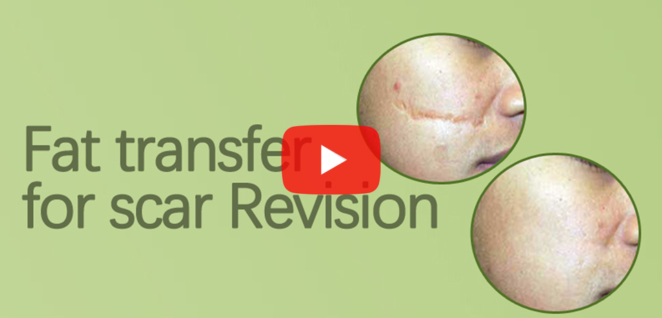 Fat Transfer For Scar Revision