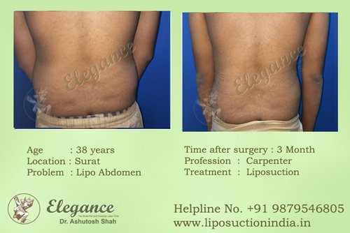 Lipo Dissolving Injections