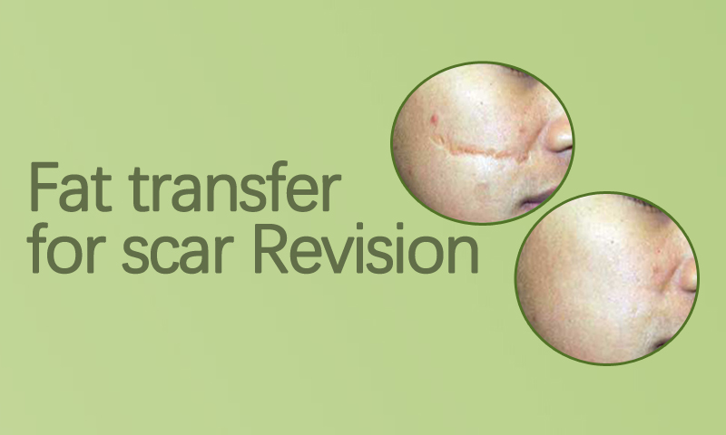 Fat Transfer For Scar Revision