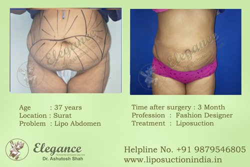 Tummy Tuck