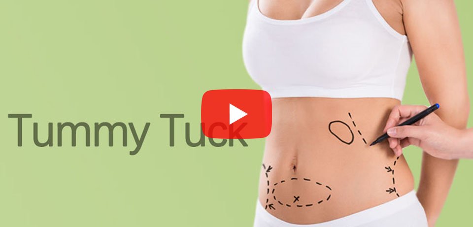 Tummy Tuck