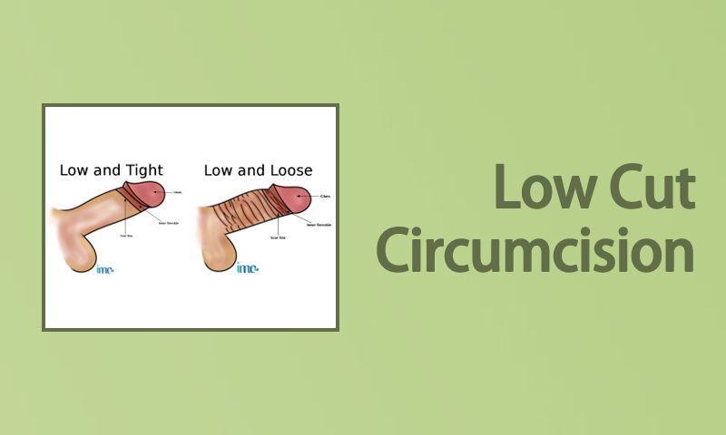 Low Cut Circumcision