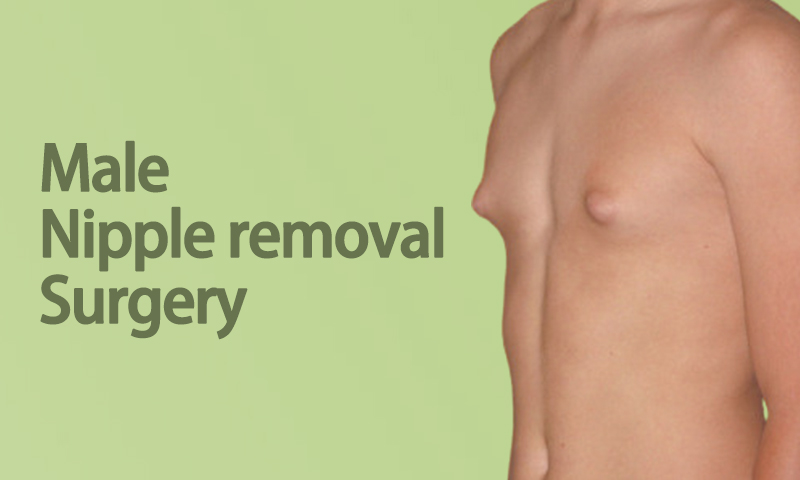 Male Nipple Removal in Surat