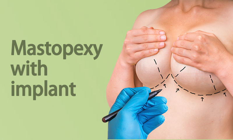 Mastopexy with Implant in Surat, Gujarat (India)