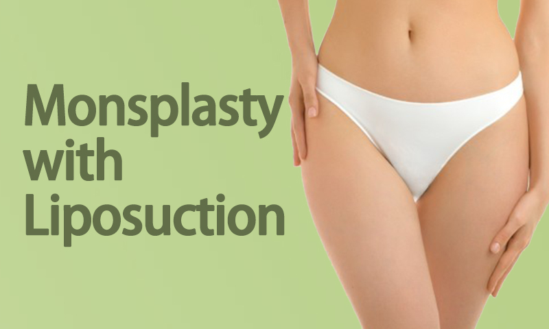 Monsplasty With Liposuction