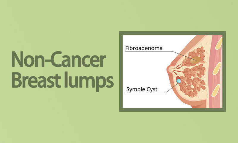 Non-Cancer Breast Lumps Treatment in Surat, Gujarat (India)